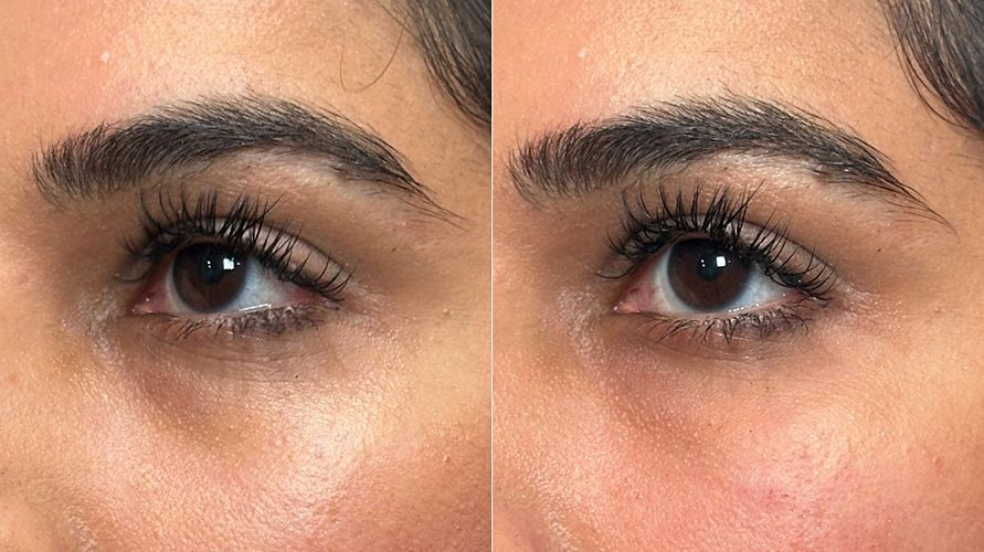 Under Eye Rejuvenation Package - CO2 Laster and Polynucleotides
